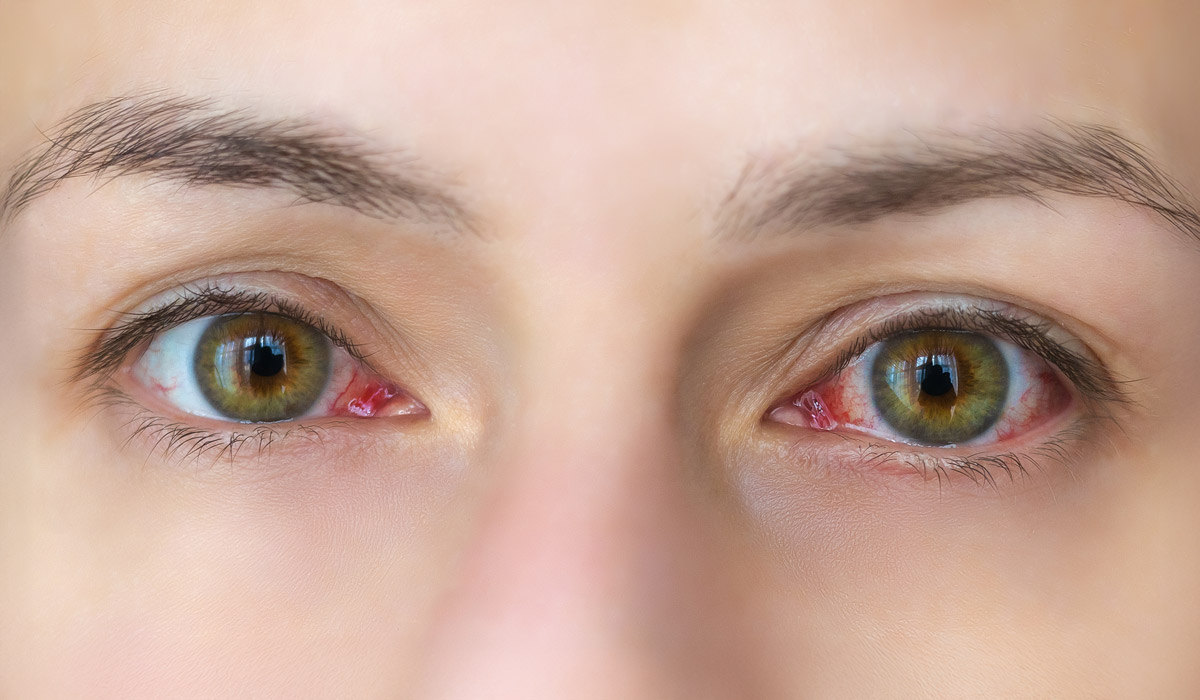Trockenes Auge